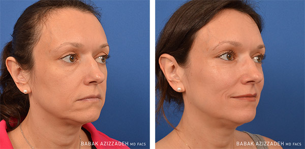 mid age woman before and after liquid facelift procedure
