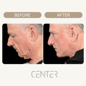 photos of man before and after a neck lift