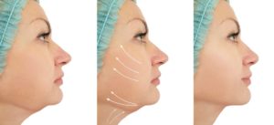 three progress pictures of a woman's chin improving from liposuction