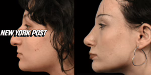 Before and After Filler Nose Job by Dr Azzizadeh