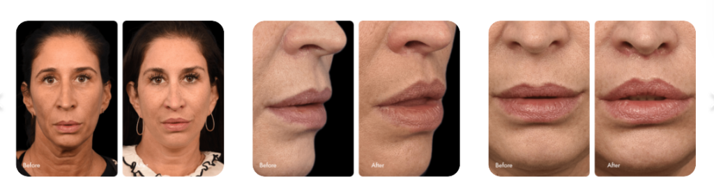 lip lift before and after