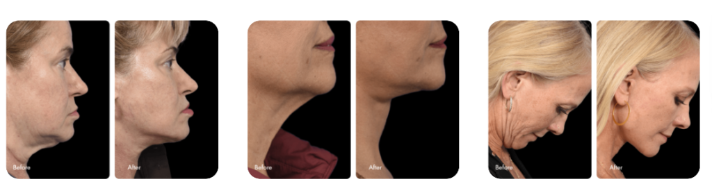 buccal fat removal before and after