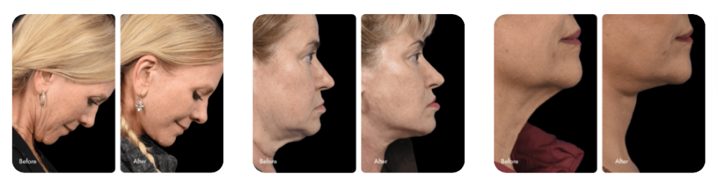 buccal fat removal before and after 3-6 months