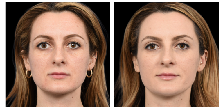 Facial Rejuvenation before and after