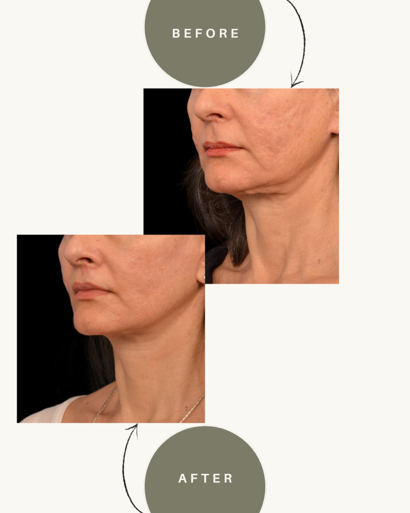 Neck Lift before and after