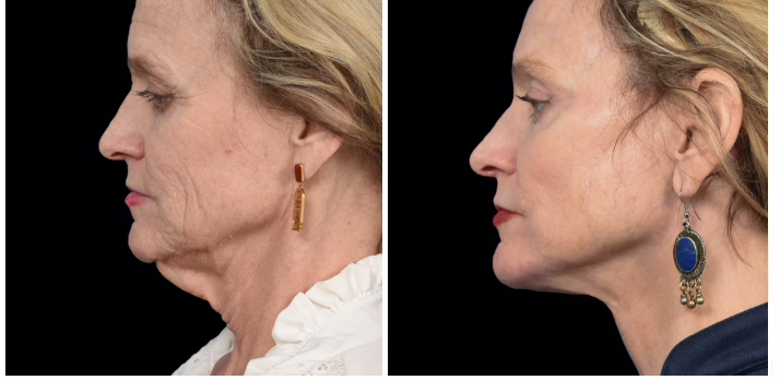 Neck Lift before and after picture