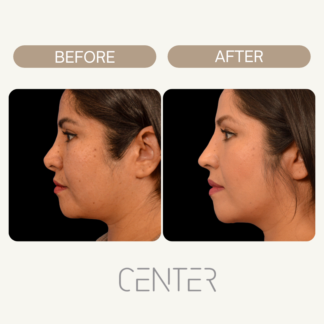 Female rhinoplasty