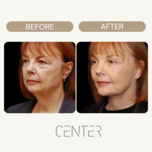 Facial Fat Grafting before and after