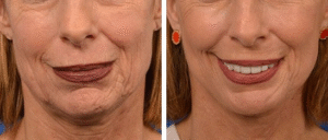 before and after images of a middle-aged woman showing reduced facial wrinkles
