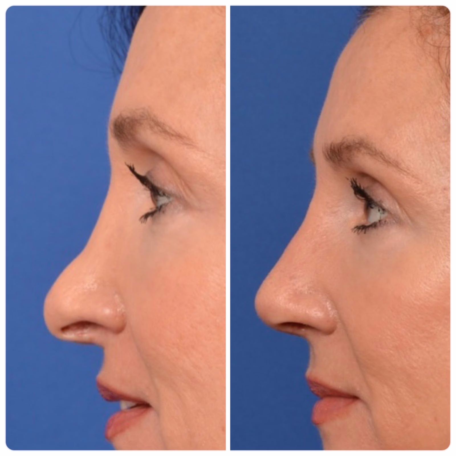 before and after a nose hump surgery