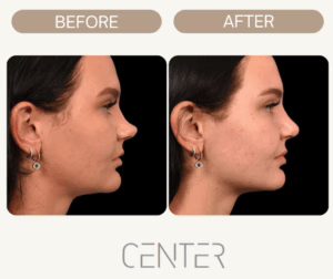 female patient nose profile rhinoplasty