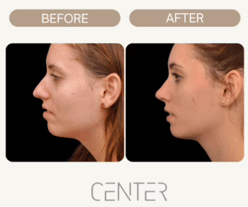 rhinoplasty before and after