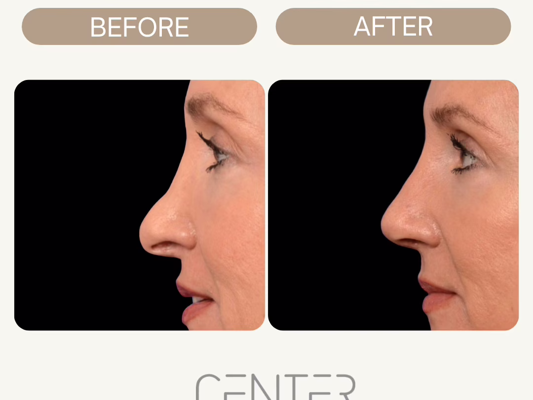 Before and After Rhinoplasty