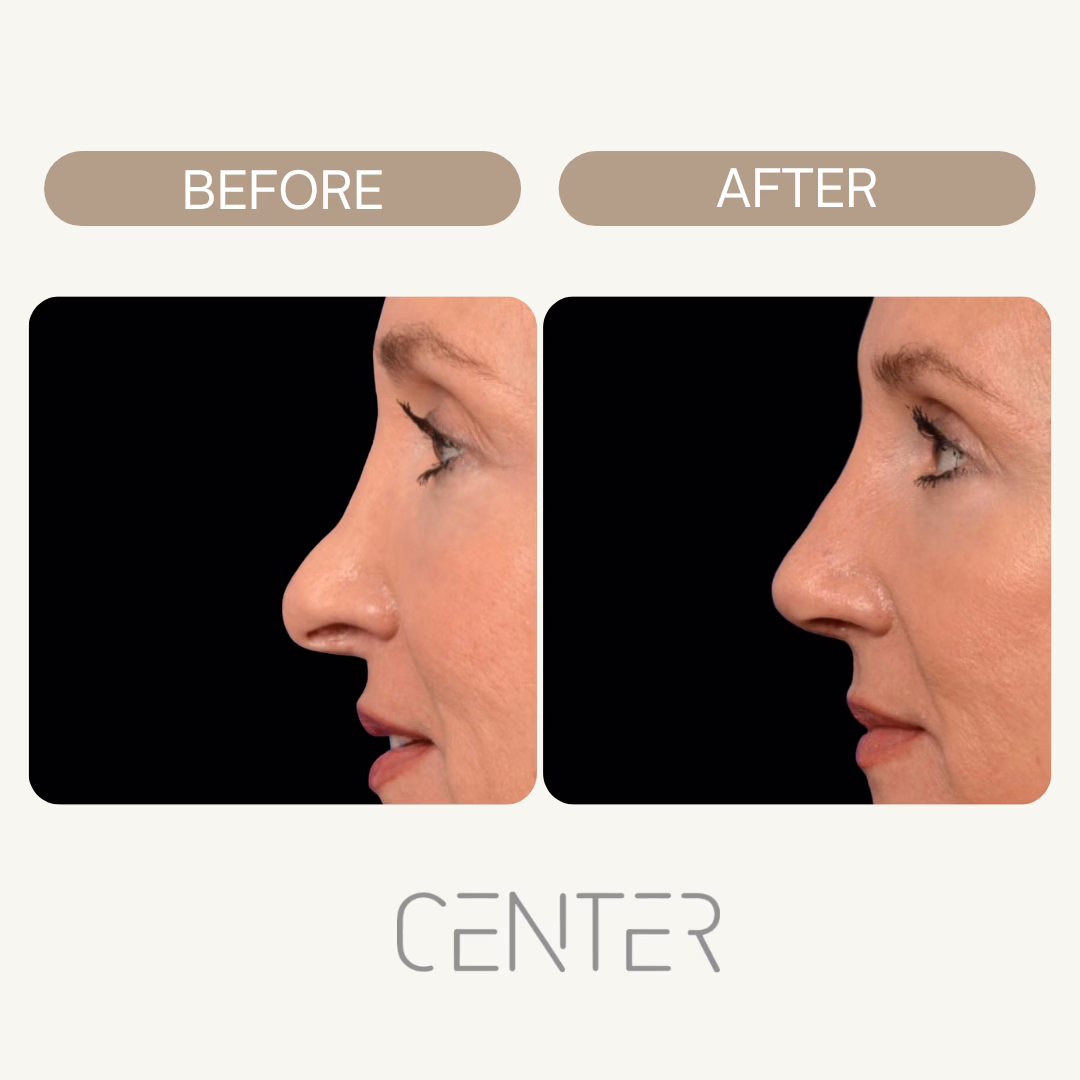 Before and After Rhinoplasty