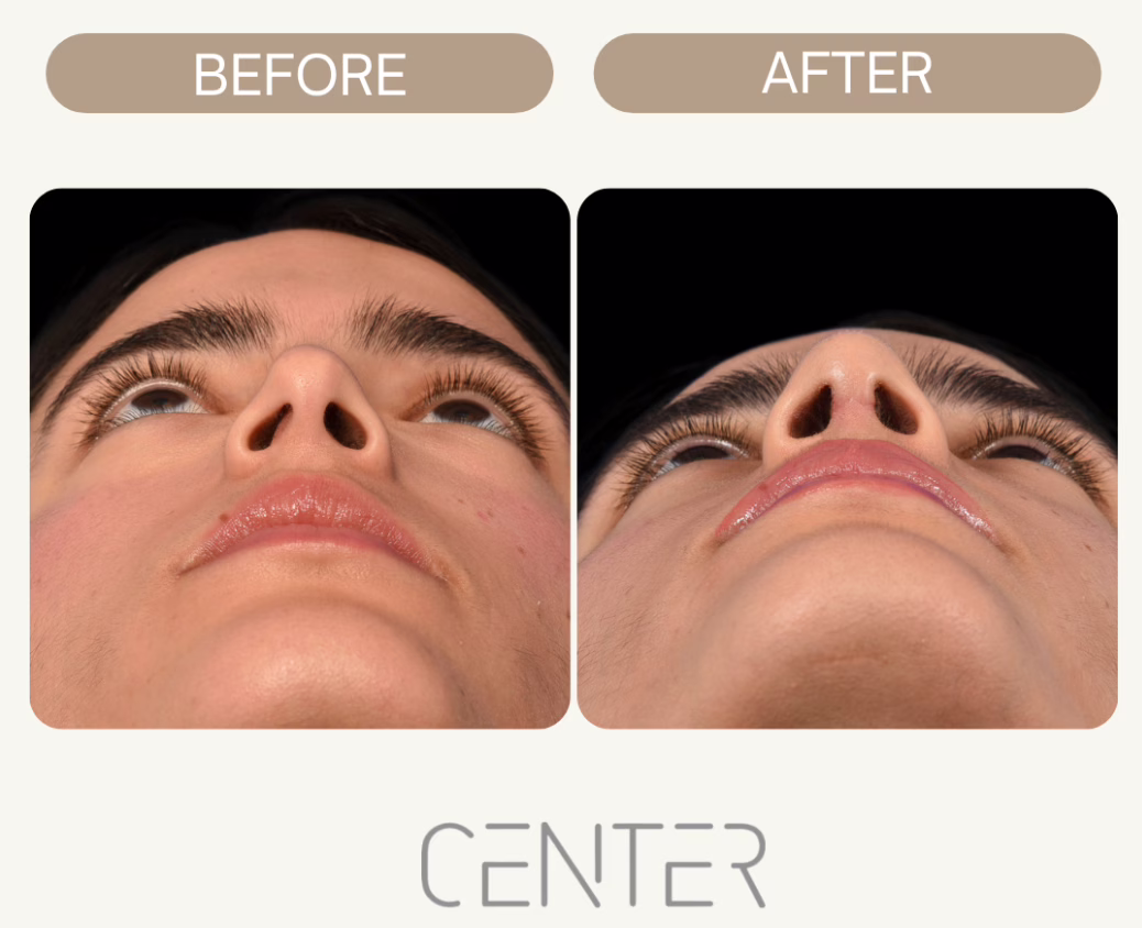 Before and After Nose Job