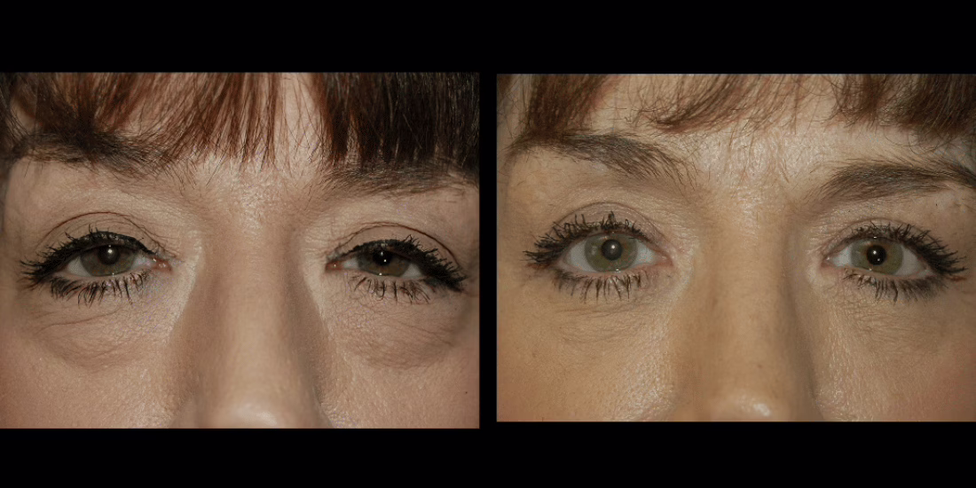 Close-up of patient with visible upper eyelid asymmetry before and after a blepharoplasty procedure