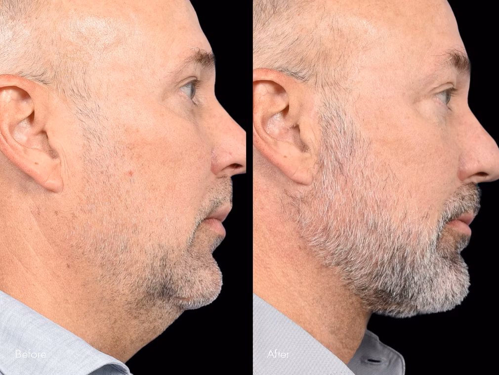 Neck lift before and after surgery