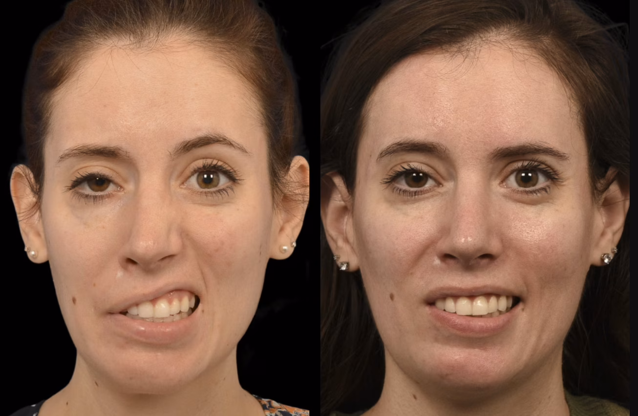  Facial Reanimation Before & After | Facial Plastics